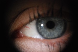 Foto: Linkes Auge, beachte die gestaute Vene welche auf den Schilddrüsenbereich deutet. 